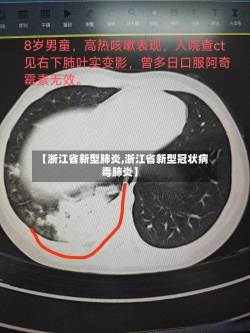 【浙江省新型肺炎,浙江省新型冠状病毒肺炎】-第2张图片