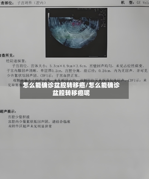 怎么能确诊盆腔转移癌/怎么能确诊盆腔转移癌呢