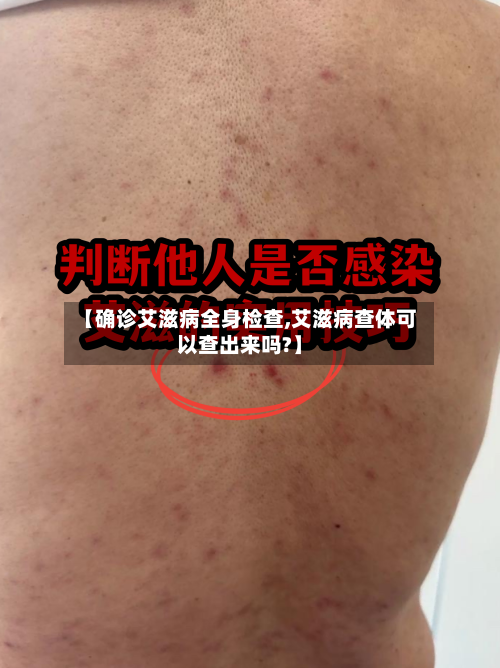 【确诊艾滋病全身检查,艾滋病查体可以查出来吗?】